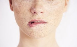 Что нужно знать о лазерной эпиляции при гиперпигментации и склонности к рубцеванию ЗДОРОВЬЕ