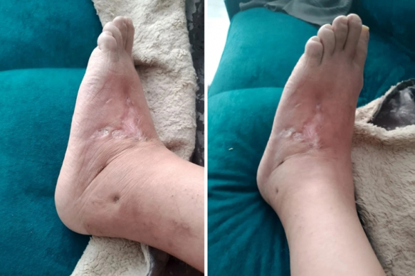 &laquo;Сына ранило под Покровском, осколочное. Потом засыпало. Еле ходит, а его за бумагами в часть гонят&raquo;